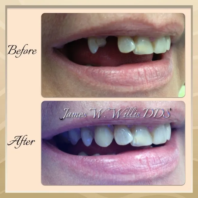 Before and after smile transformation — case 1, treated at Crozet Family Dental