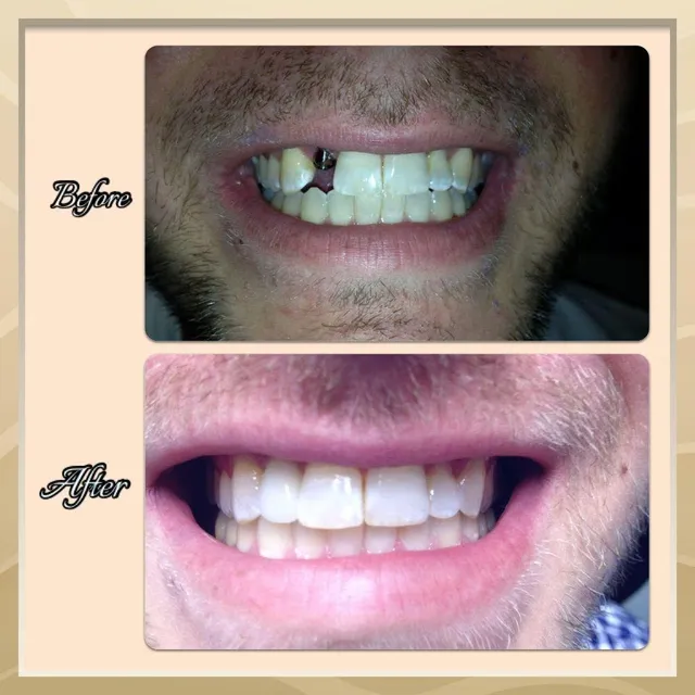 Before and after smile transformation — case 2, treated at Crozet Family Dental