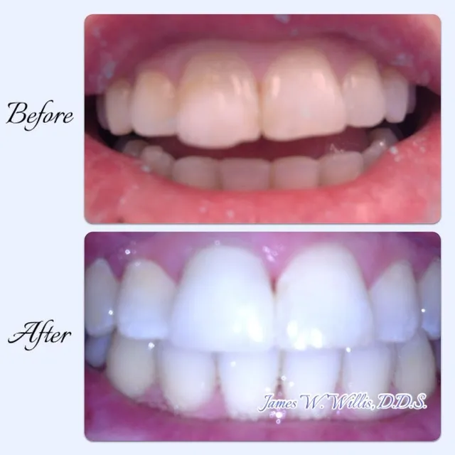 Before and after smile transformation — case 3, treated at Crozet Family Dental