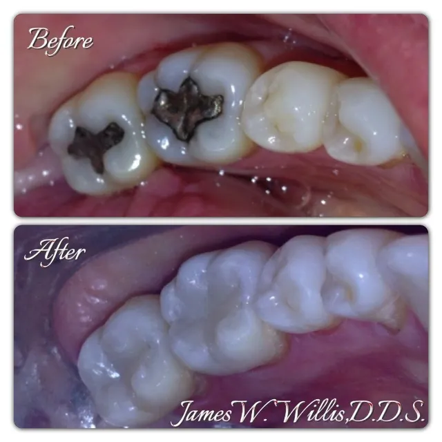 Before and after smile transformation — case 4, treated at Crozet Family Dental