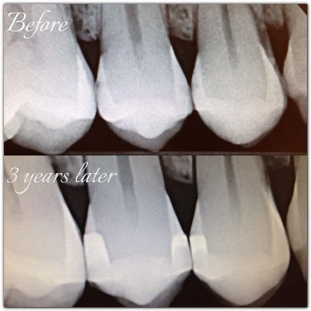 Before and after smile transformation — case 5, treated at Crozet Family Dental