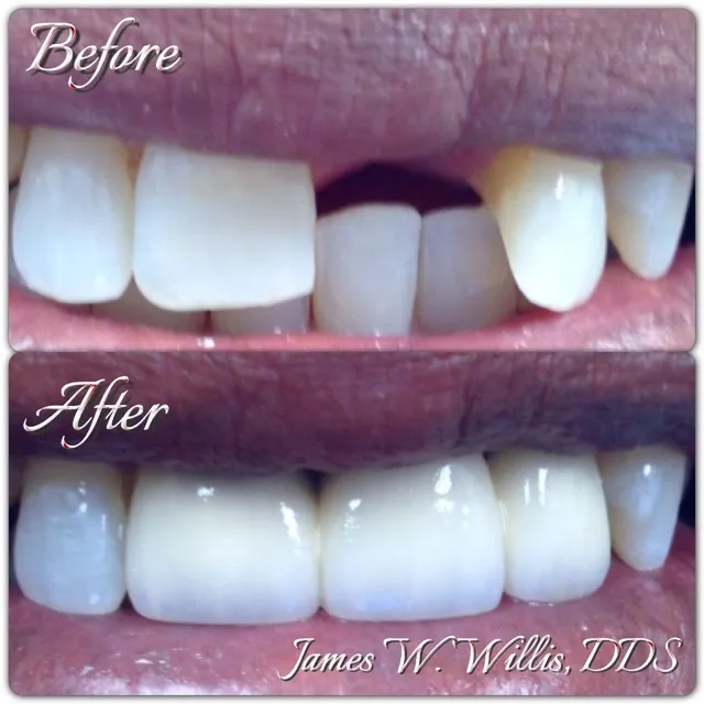 Before and after smile transformation — case 6, treated at Crozet Family Dental