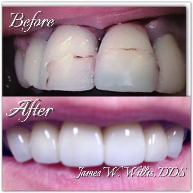 Before and after smile transformation — case 7, treated at Crozet Family Dental
