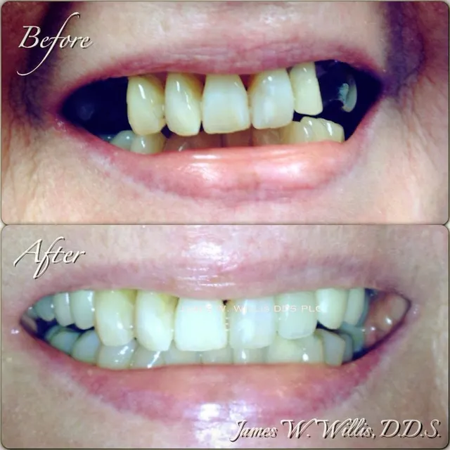 Before and after smile transformation — case 8, treated at Crozet Family Dental