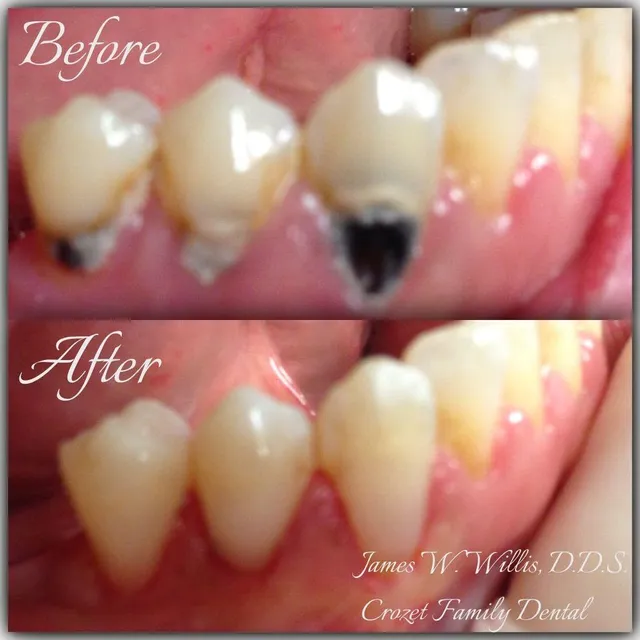 Before and after smile transformation — case 9, treated at Crozet Family Dental