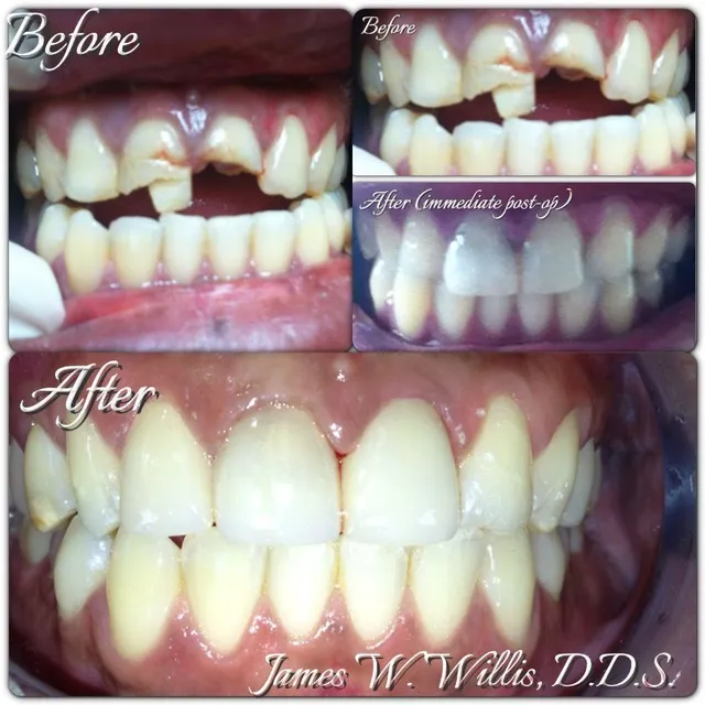 Before and after smile transformation — case 10, treated at Crozet Family Dental