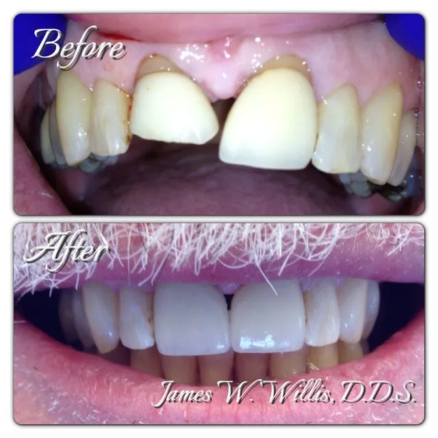 Before and after smile transformation — case 11, treated at Crozet Family Dental