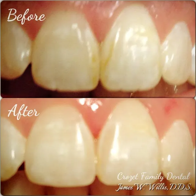 Before and after smile transformation — case 12, treated at Crozet Family Dental