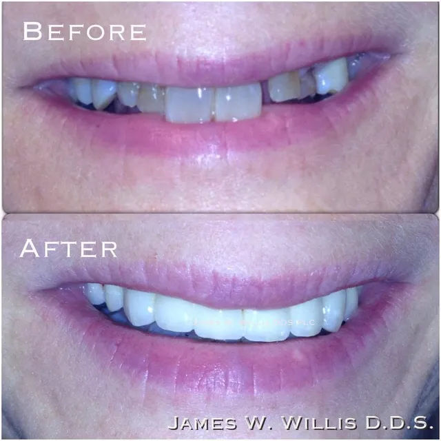 Before and after smile transformation — case 13, treated at Crozet Family Dental