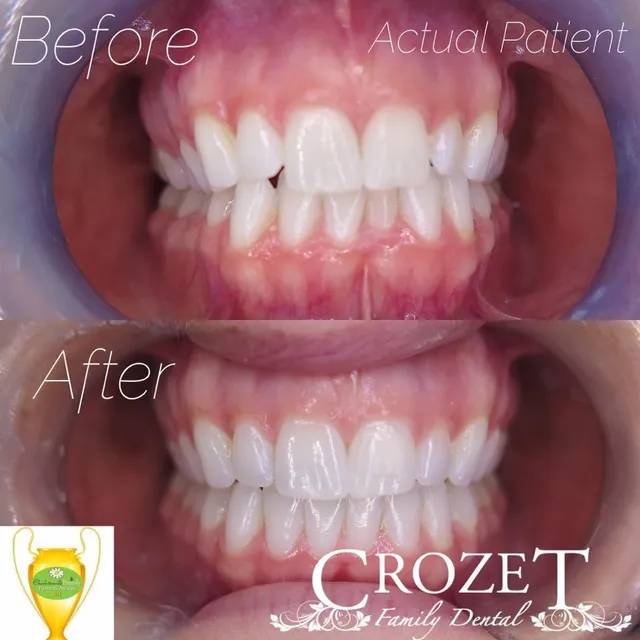 Before and after smile transformation — case 15, treated at Crozet Family Dental