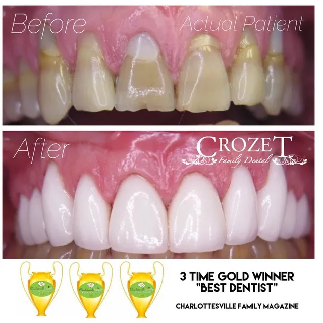 Before and after smile transformation — case 16, treated at Crozet Family Dental
