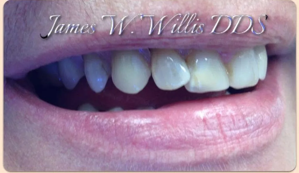 After: restored complete smile, treated at Crozet Family Dental