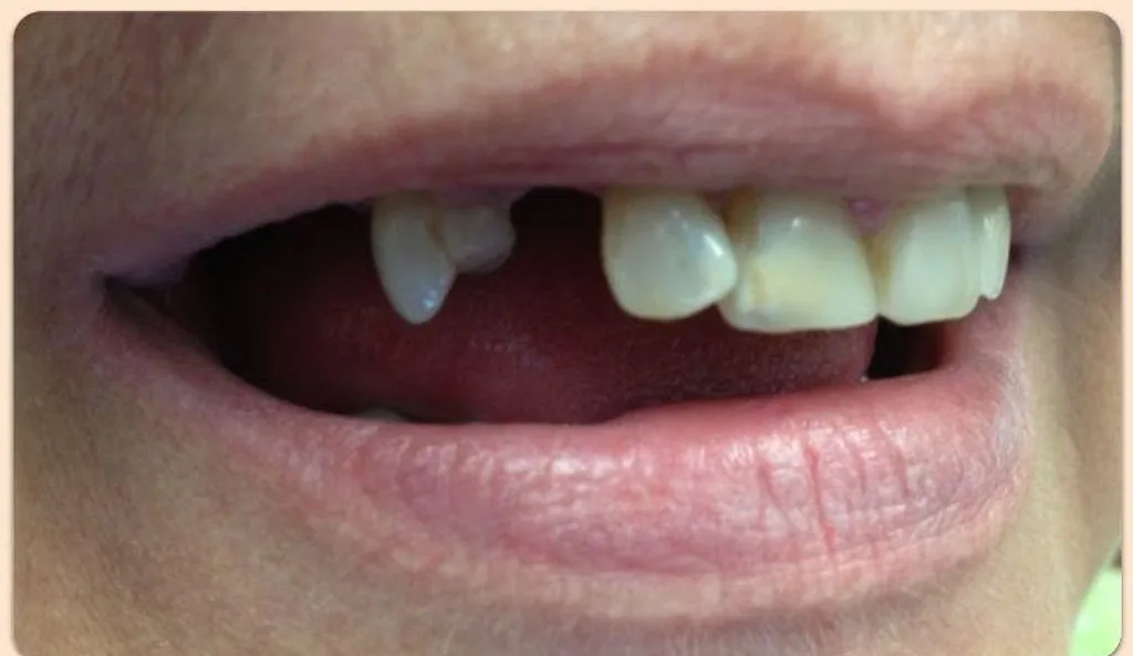 Before: smile with a missing front tooth, treated at Crozet Family Dental